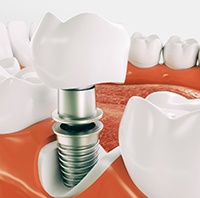 Diagram of a dental implant’s components