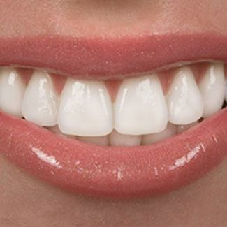 woman with big smile after porcelain veneer placement