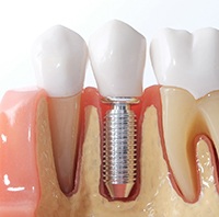 Model showing how dental implants work
