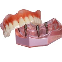 Model smile with All-on-4 dentures