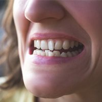 crooked teeth/bite before Invisalign tray