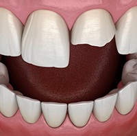 Image of a chipped front tooth needing treatment.