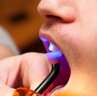 Man in dental chair for direct bonding treatment.