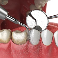 computer illustration of a teeth cleaning