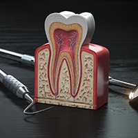 model of a tooth with dental tools