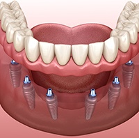 Implant Dentures are attached to the jaw via several dental implants