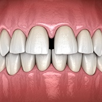 A digital image of a smile that includes a gap between the two upper front teeth