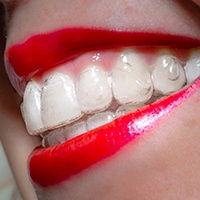 An up-close image of a person’s smile and an Invisalign aligner sitting on the top row of teeth