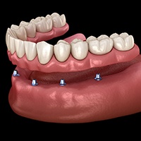 Diagram of an implant denture in Parker