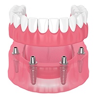 Diagram of an implant denture