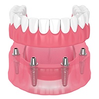 Diagram of an implant denture in Parker