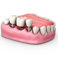 An implant bridge