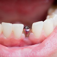 closeup of patient smiling after getting dental implant