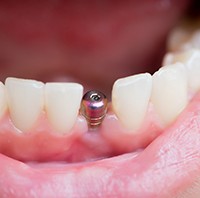 closeup of patient smiling after getting dental implant in Parker