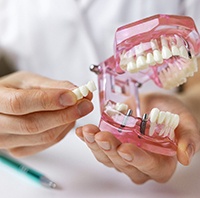 closeup of implant bridge