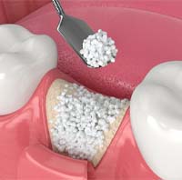 illustration of bone grafting for dental implants in Parker