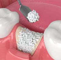 illustration of bone grafting for dental implants