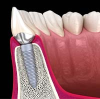 illustration of a ridge expansion for dental implants in Parker