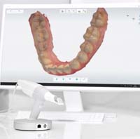 dental impression on a computer monitor