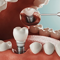 Diagram of a dental implant in Parker being integrated.