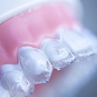 Clear aligner on dental mold.