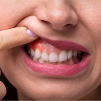 Woman showing red gums during oral cancer screening
