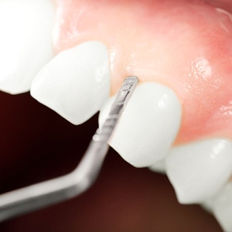 Closeup of smile receiving periodontal therapy