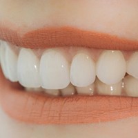 close up of a straight white smile after periodontal therapy