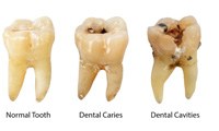 Stages of tooth decay