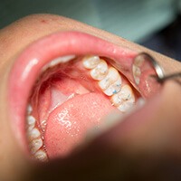 Person examined with dental mirror after root canal therapy