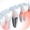 Animated dental implant