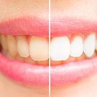 Before and after of smile after teeth whitening
