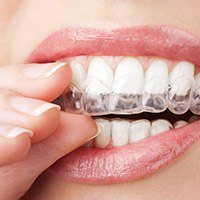 Woman placing teeth whitening trays