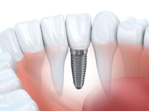 Your dentist provides dental implants in Parker for a complete smile.