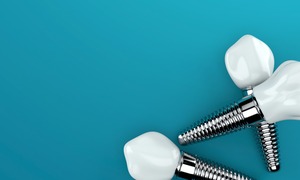 Dental implants and crowns in a pile
