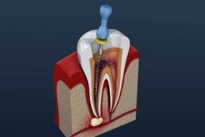 Root canal therapy for infected tooth