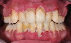 Close up of mouth with advanced gum disease