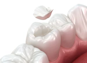 Artistic rendering of tooth-colored filling